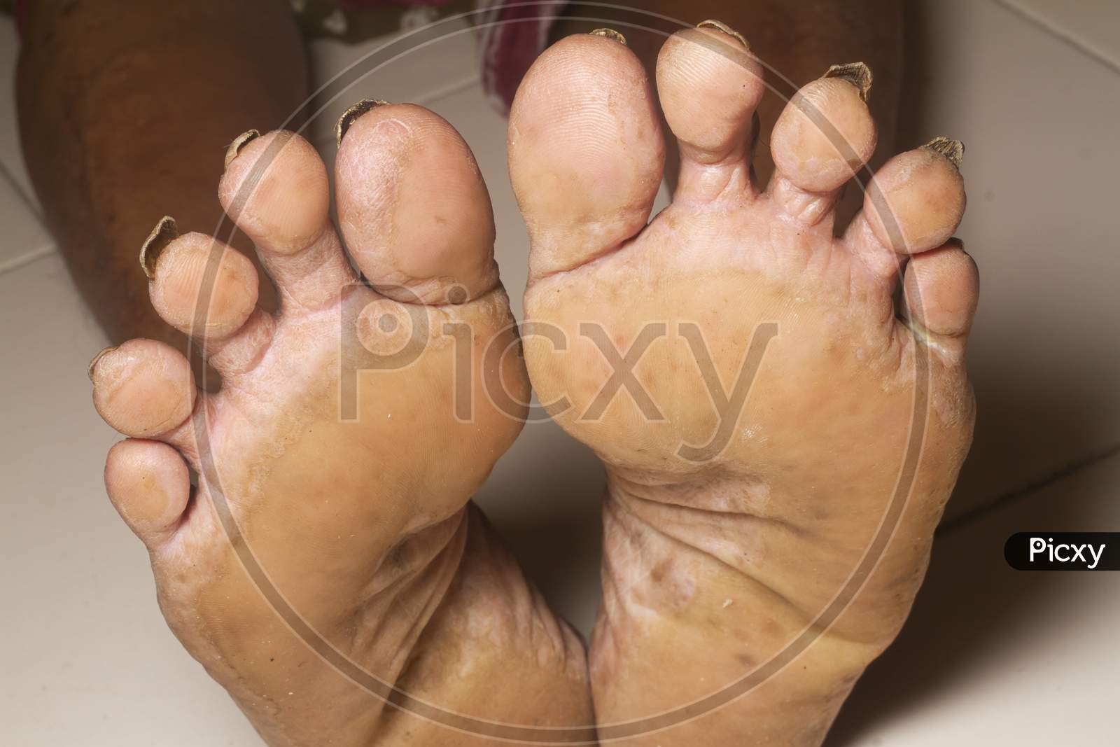 Image of The Underside Of The Foot Of An Old Woman With Calluses  .-XM643306-Picxy