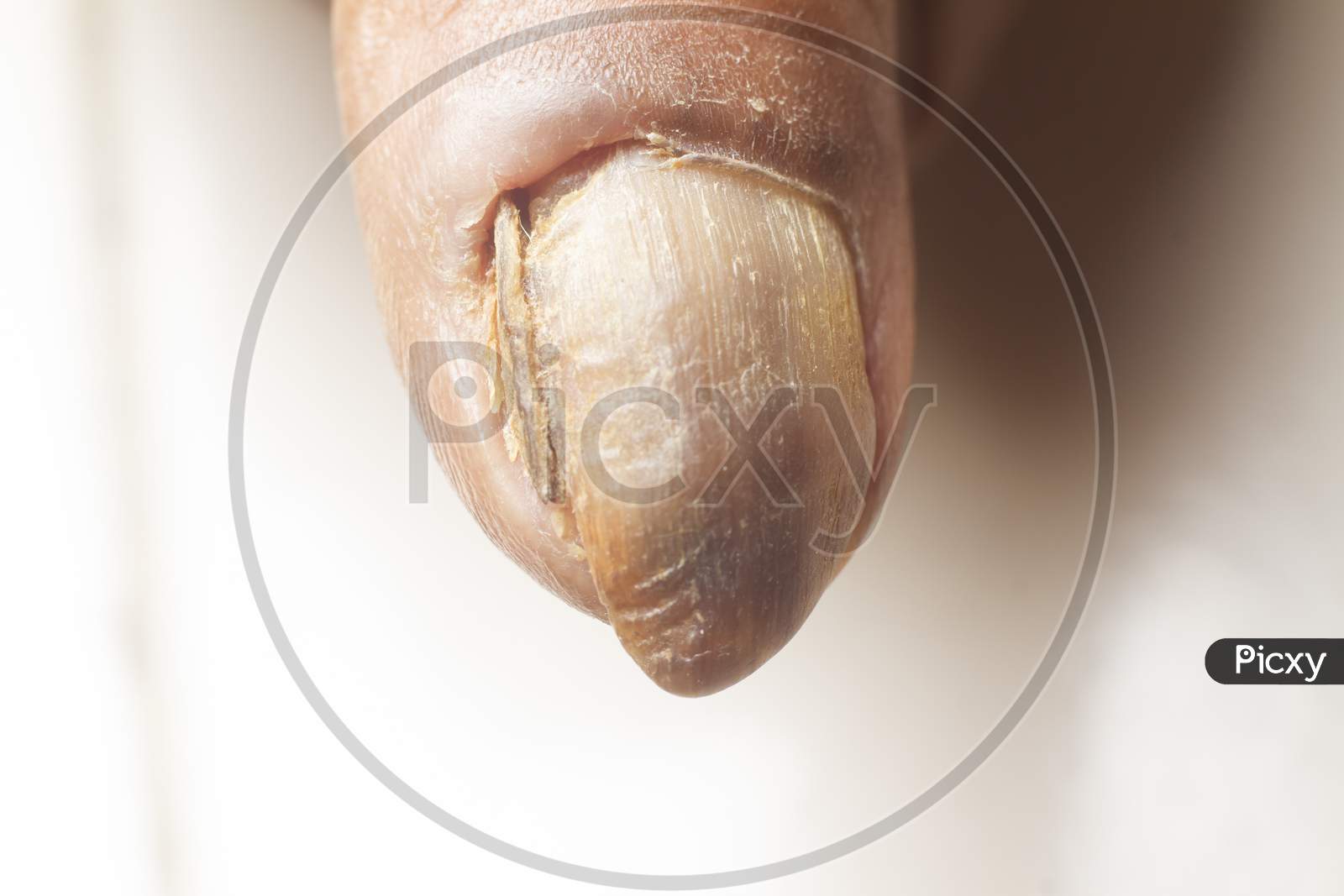 Close Nail Fungus Infection On Thumb Stock Footage Video (100%  Royalty-free) 1019445556 | Shutterstock