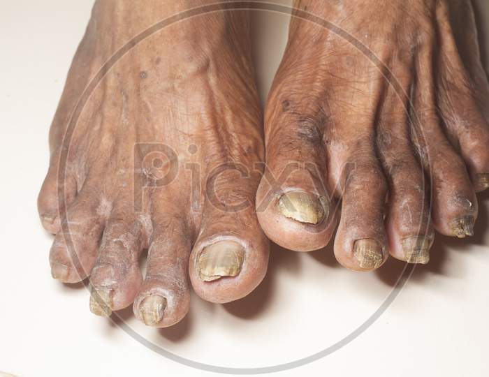 Fungus Infection On Nails Of Old Woman'S Foot