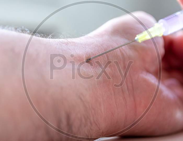 Man gets an injection for local anesthesia to reduce pain in his hand and get a healthy infusion through the injection needle as infusion therapy and cure of sickness