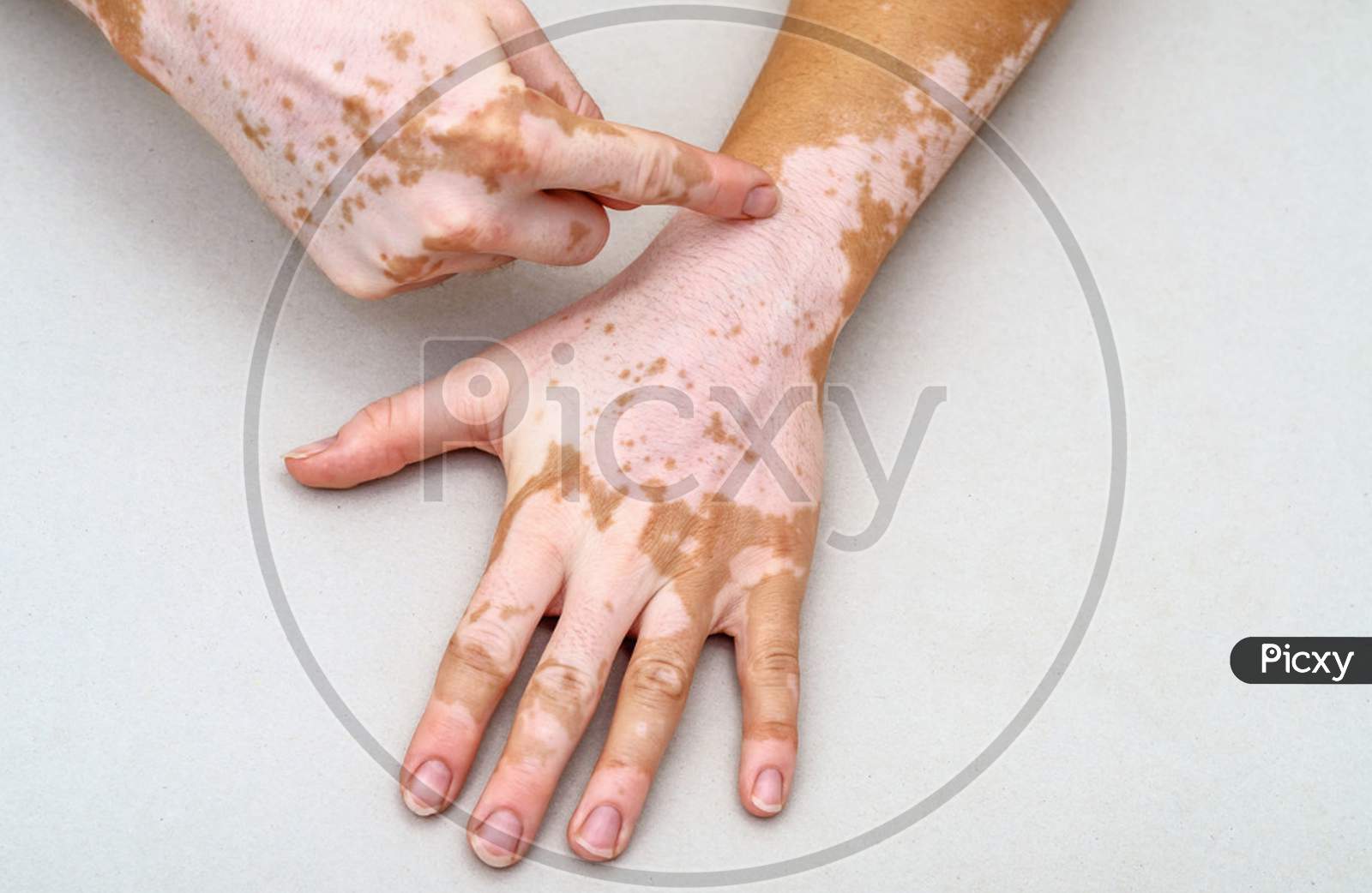 Vitiligo On The Skin Of Hands. Finger Indicates Skin Defect.