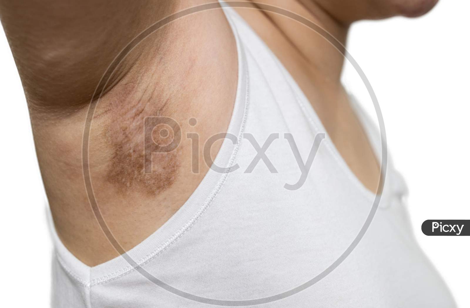 Image of young woman showing a scar on the skin of the armpits