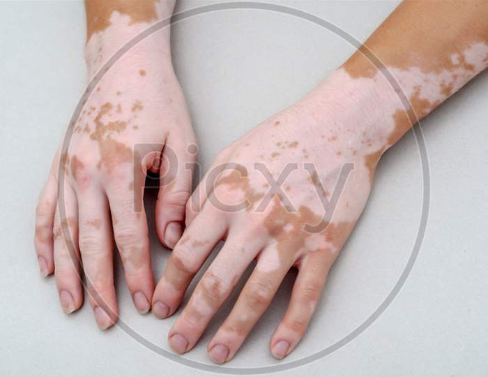 Vitiligo On Skin Of Hands.