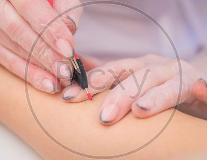 The Doctor Makes Electro Epilation Of The Woman'S Hands In The Salon. Close-Up Of Hardware Removal Of Unwanted Hair Forever