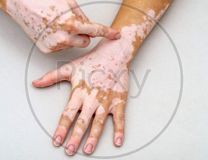 Vitiligo On The Skin Of Hands. Finger Indicates Skin Defect.