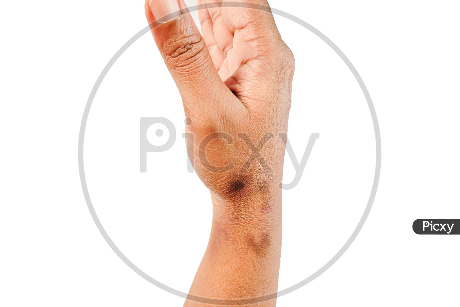 Dry, Dehydrated Close Up View Of Asian Women Hand With Multiple Deep Black Marks Dermatitis Problem Of Rash ,Allergy Rash
