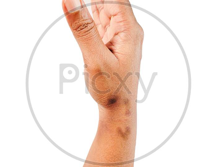 Dry, Dehydrated Close Up View Of Asian Women Hand With Multiple Deep Black Marks Dermatitis Problem Of Rash ,Allergy Rash