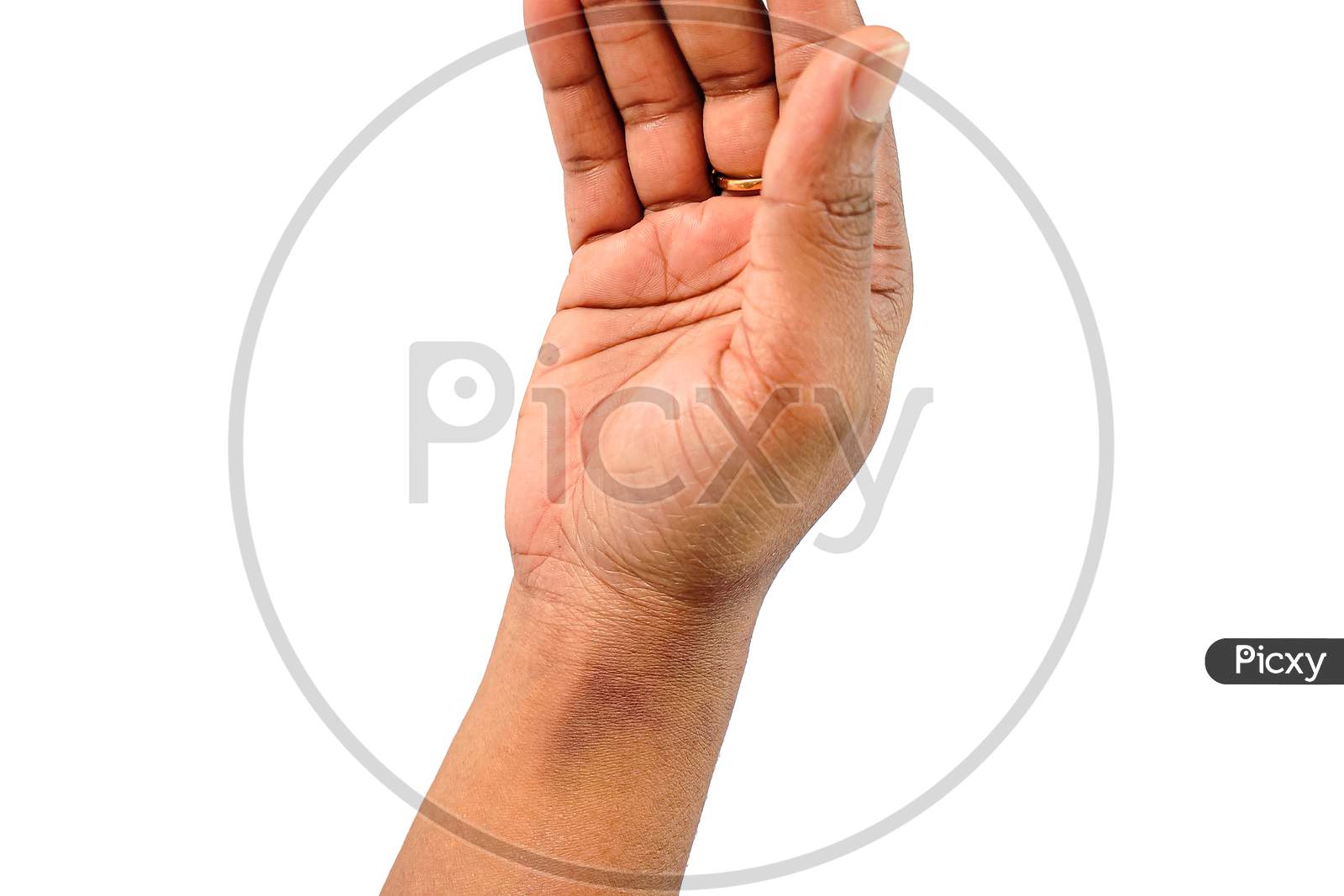 Close Up View Of Asian Women Hand With Light Sunburn Marks Dermatitis Problem Of Rash ,Allergy Rash