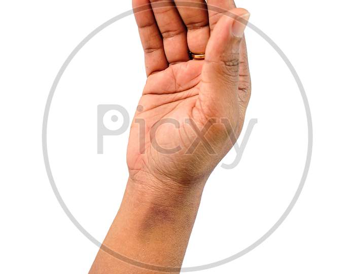 Close Up View Of Asian Women Hand With Light Sunburn Marks Dermatitis Problem Of Rash ,Allergy Rash