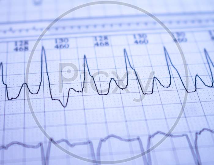 Close-Up Of Heartbeats Recorded On The Paper Of The Electrocardiogram. Selective Focus. Approach To A Cardiac Arrhythmia.