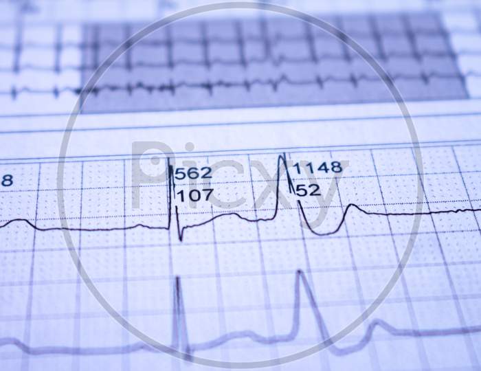 Close-Up Of Heartbeat Recorded On Paper. Electrocardiogram With Cardiac Arrhythmia. Ventricular Extrasystoles Recorded