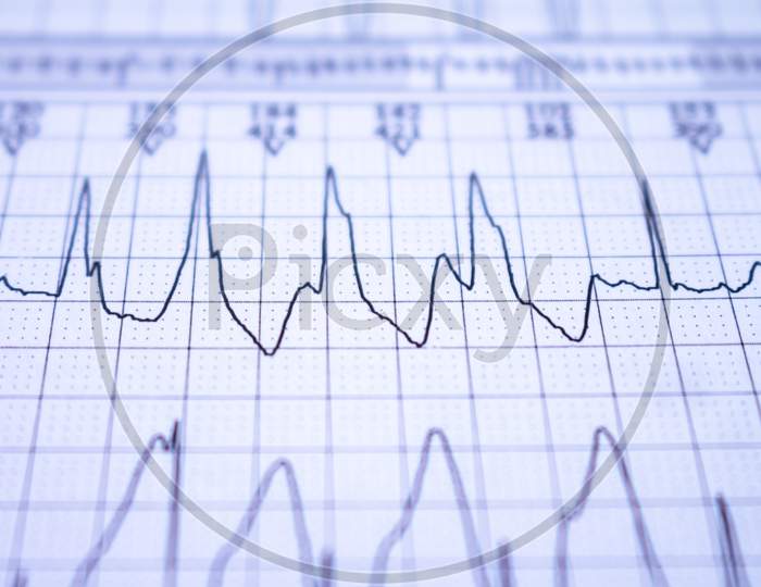 Ekg Tracing With Heartbeat. Waves With The Electrical Activity Of The Heart.