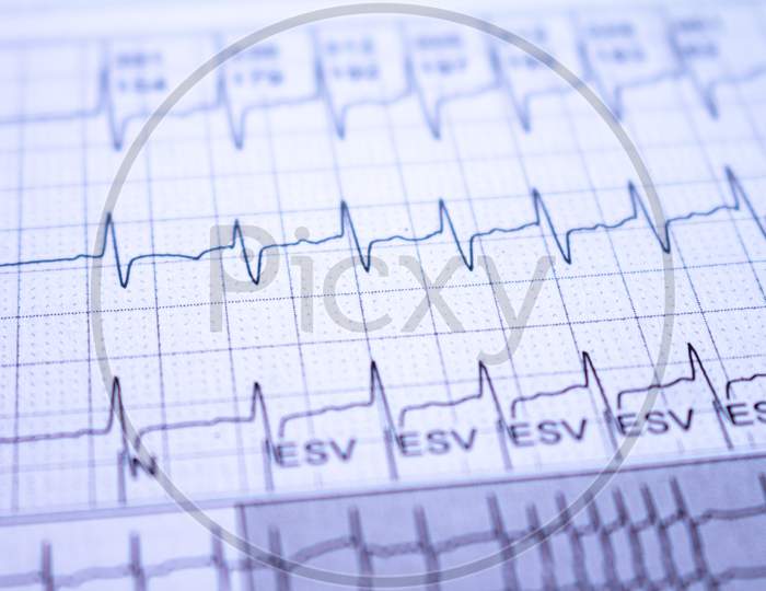 Ekg Tracing With Heartbeat. Study For The Heart. Waves With The Electrical Activity