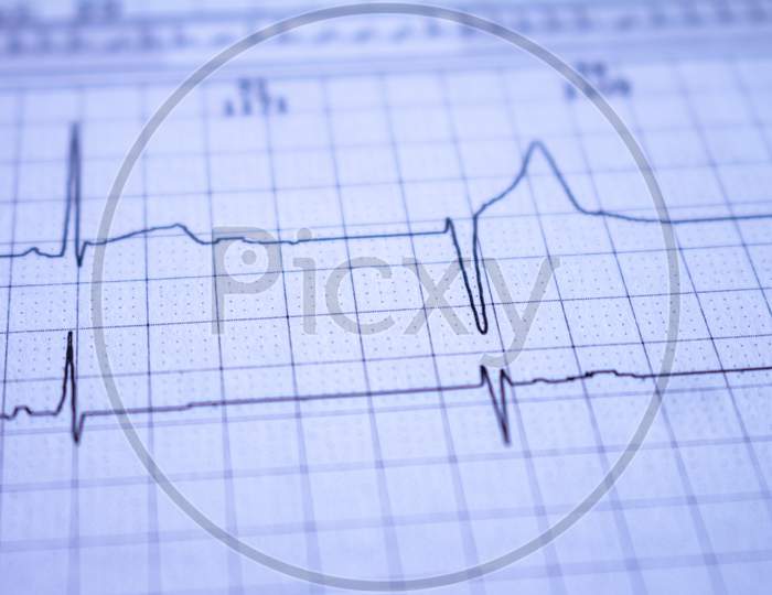 Heartbeat Recorded On Graph Paper Called An Electrocardiogram. Study Of The Functioning Of The Heart Post Covid-19.
