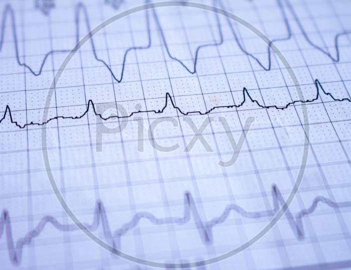 Close-Up On An Electrocardiogram. Heartbeat Written On Paper. Study Of The Heart.