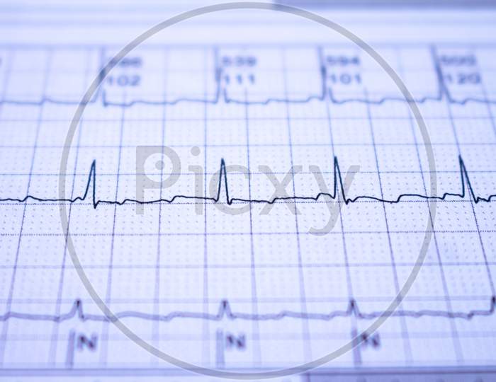 Electrocardiogram With Cardiac Arrhythmia. Atrial Fibrillation Recorded As The Origin Of Many Cerebrovascular Accidents Or Strokes.