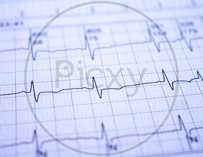 Close-Up Of An Electrocardiogram Of A Patient. Heartbeats Recorded As Waves On Paper.