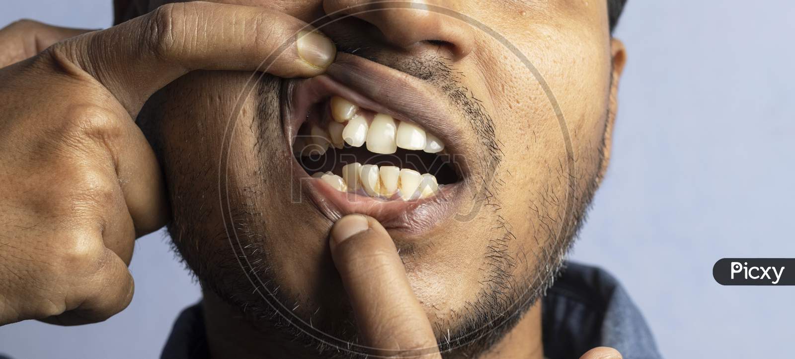 An Indian Man Showing Extra Irregular Teeth
